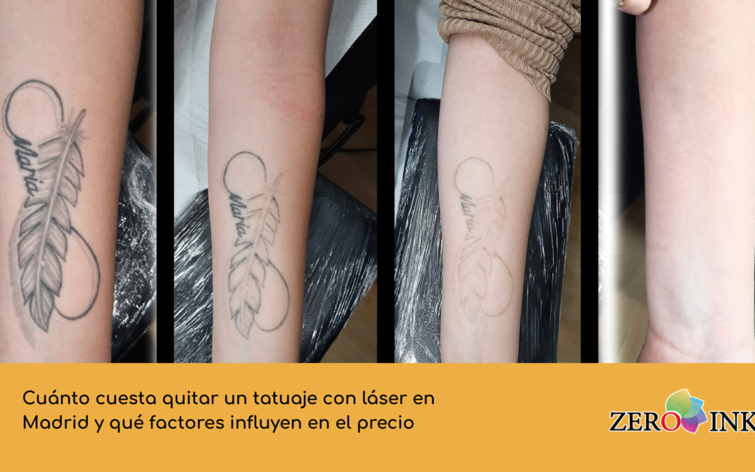 Cuánto cuesta quitar un tatuaje con láser en Madrid y qué factores influyen en el precio