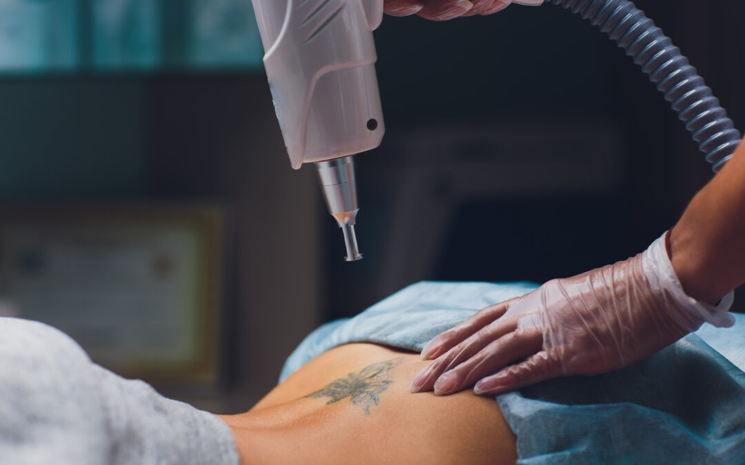Cuánto cuesta quitar un tatuaje con láser en Madrid y qué factores influyen en el precio